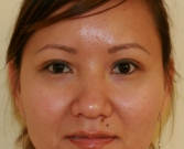 Feel Beautiful - Eyelid Surgery San Diego Case 42 - After Photo